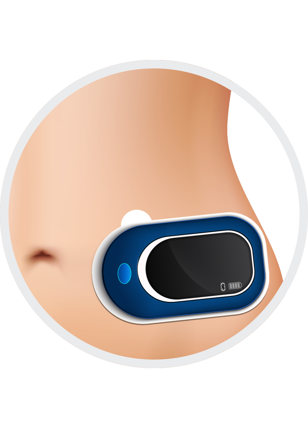 Wearable Infusion Systems